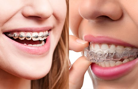 5 Tips On How To Get Affordable Adult Or Teen Braces